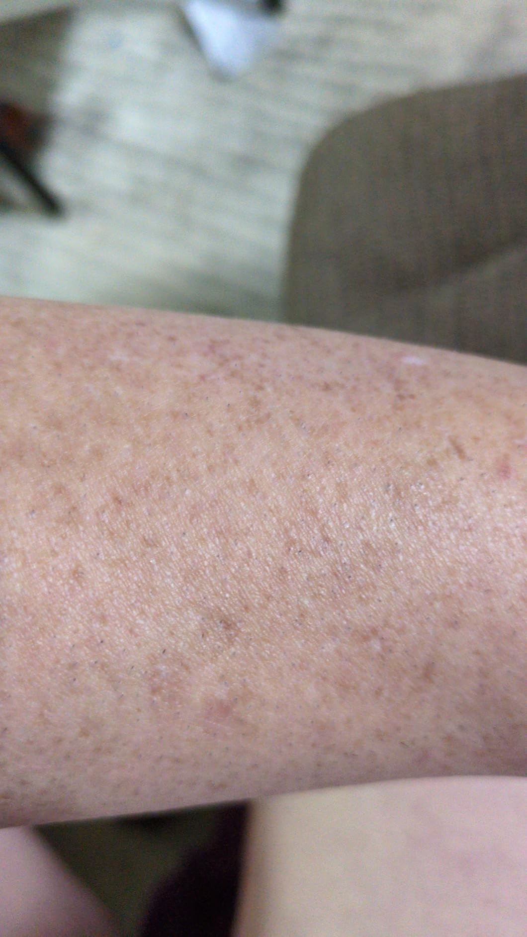 Nood Flasher Pro | IPL Laser Hair Removal Device, Clinical-Grade Permanent Results At Home, CryoSoothe Tech with 5 Power Settings, Pain-Free 10 Min Sessions customer photo 2